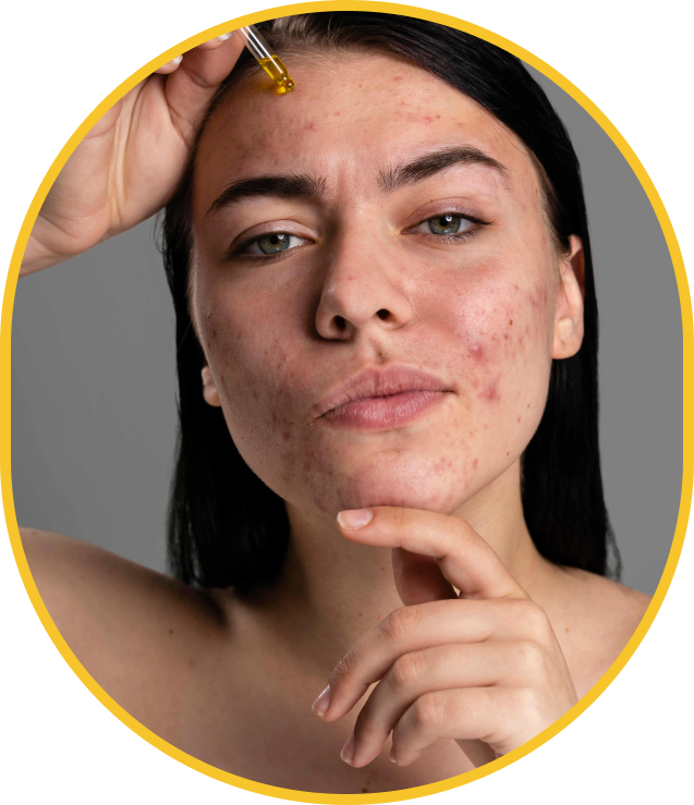 Application d'un sérum lors d'un traitement de l'acné adulte à Montréal par une professionnelle en clinique médico-esthétique.