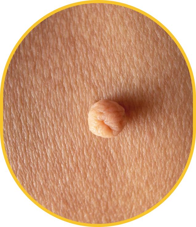 Professionnelle en clinique médico-esthétique évaluant une excroissance cutanée sur le visage d'une patiente.