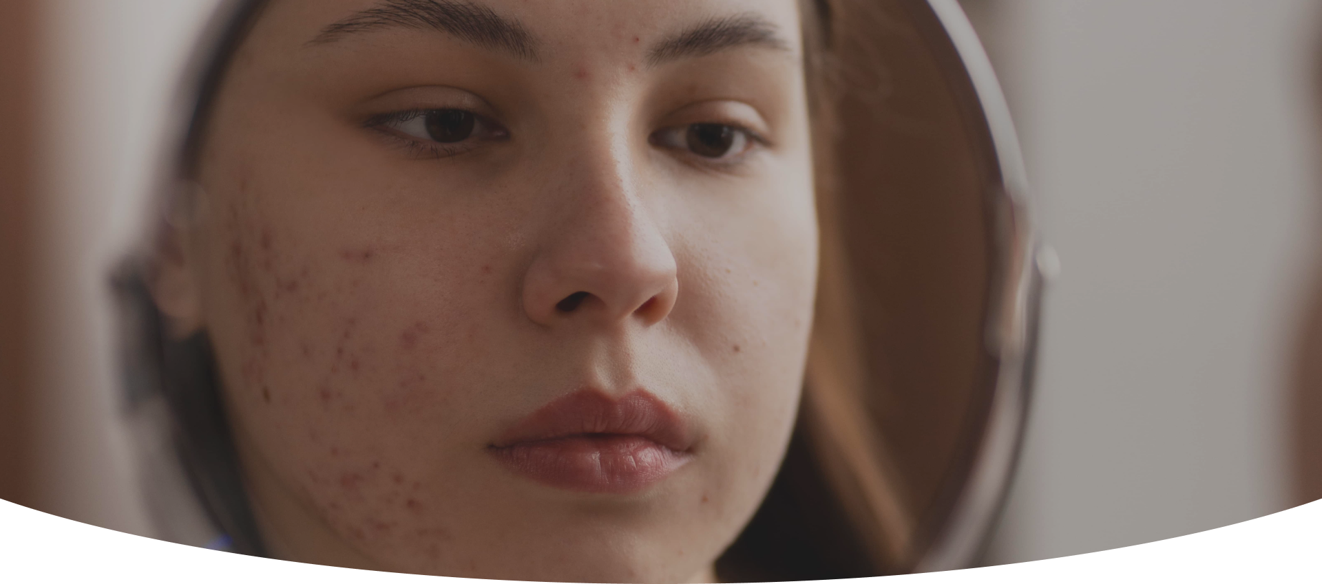 Professionnelle appliquant un traitement de l'acné adulte sur le visage d'une patiente, dans une clinique anti-âge à Montréal.