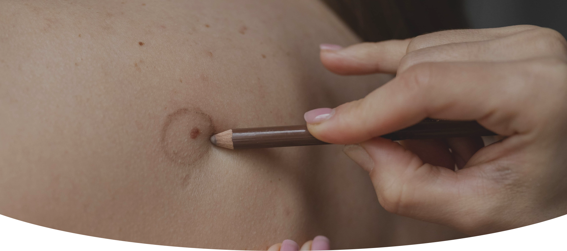 Cou d'une femme avec un bouton de sang sur la peau, plusieurs lésions vasculaires bénignes visibles sur peau claire et lisses.