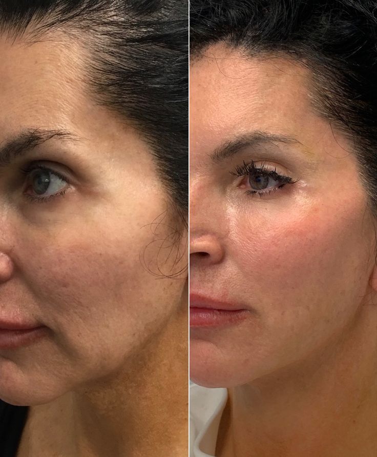 Before and after photos displaying the results of Botox nose slimming on a patient. 