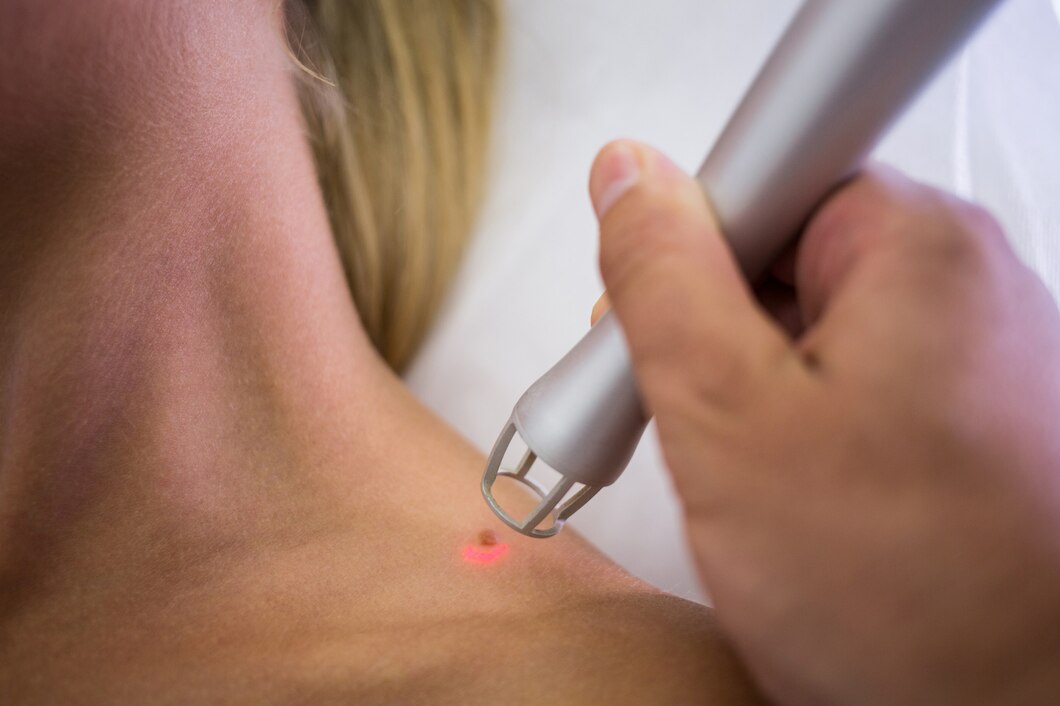 Dermatologue utilisant un laser pour enlever un grain de beauté sur l'épaule.
