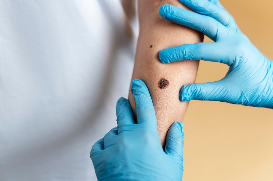 Le médecin examine un bras pour décider si le grain de beauté doit être enlevé.