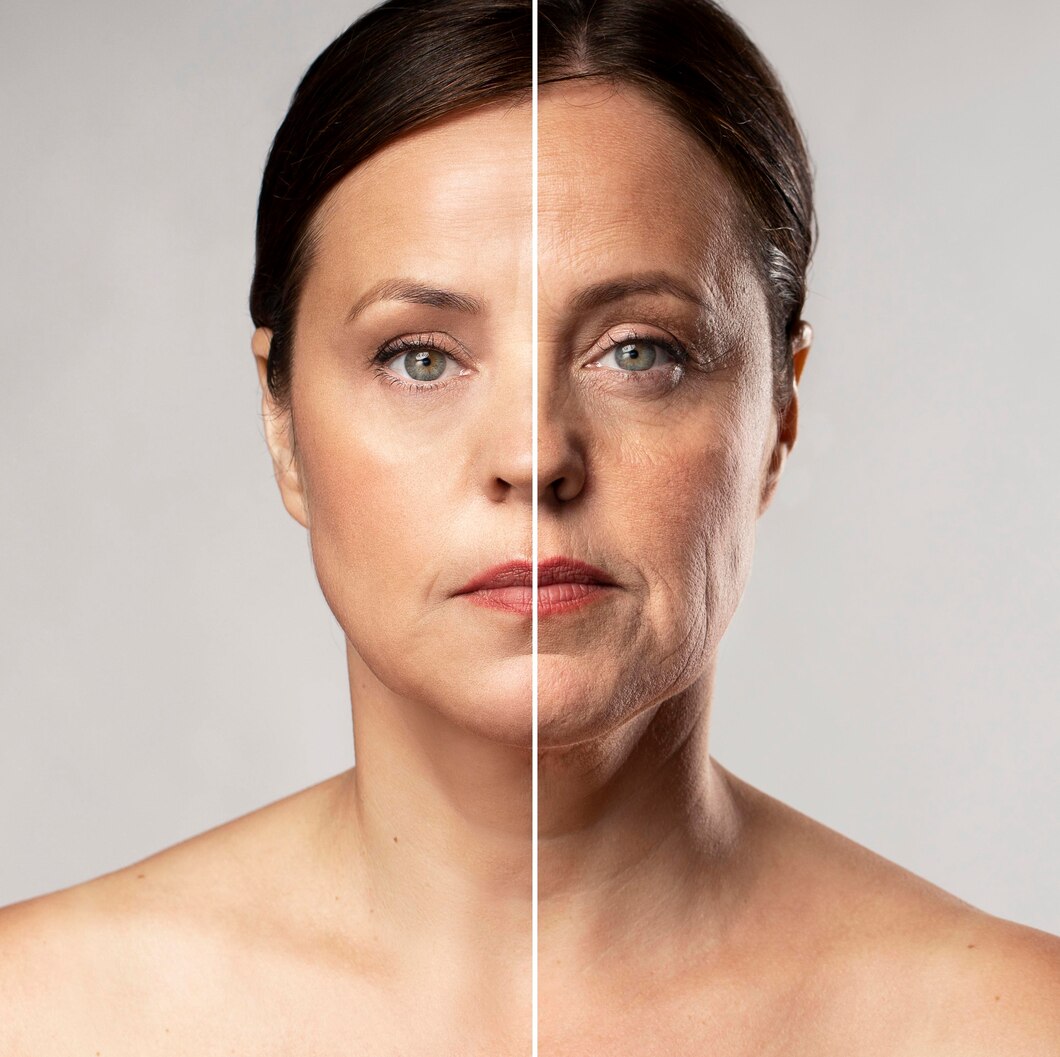 Comparaison avant et après d'une femme ayant subi un traitement de microneedling : rides visibles et teint irrégulier à gauche, peau plus lisse et uniforme à droite.