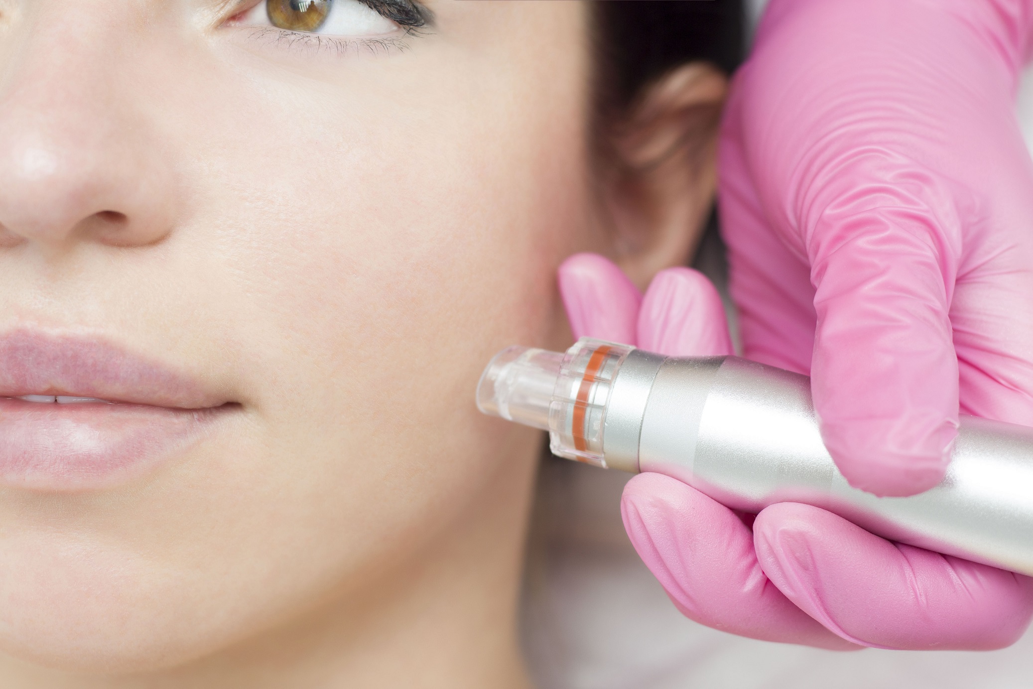 Patiente subissant un traitement de microneedling du visage pour une peau éclatante.