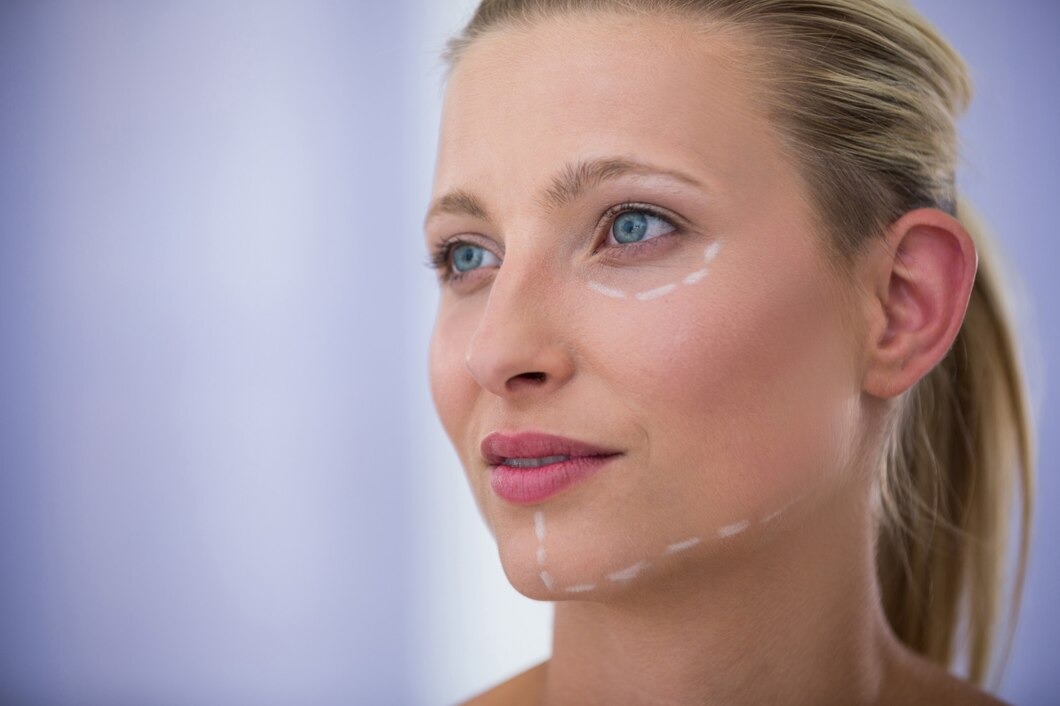 Femme préparée pour un fil tenseur visage avec des lignes de traitement.