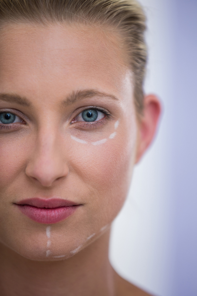 Femme préparée pour une procédure esthétique avec des marques sur le visage, illustrant un traitement des cernes sous les yeux en clinique.