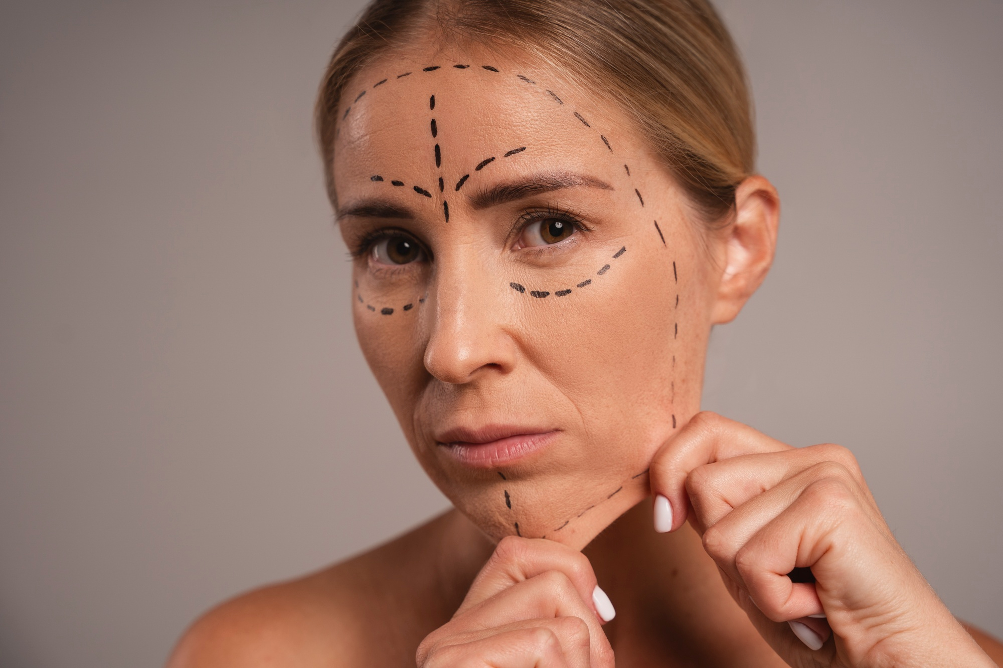 Femme avec marquages faciaux indiquant les zones d’un thread lift, illustrant la planification d’un lifting par fils tenseurs du visage.