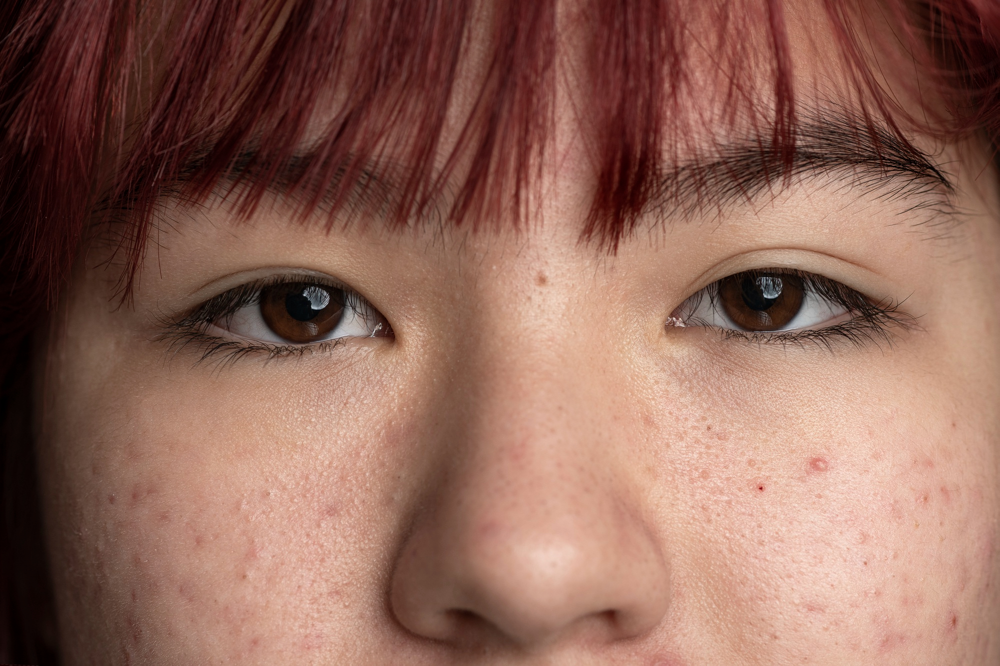 Close-up of facial skin showing small white bumps near the pores, illustrating the visible texture differences between milia and whiteheads.