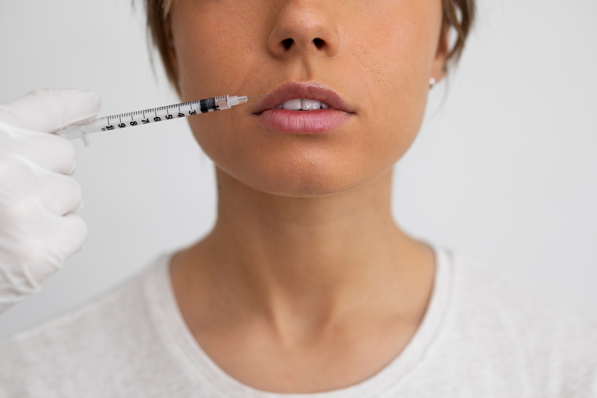 Vue rapprochée d'une femme recevant une injection dans la lèvre supérieure en clinique, geste caractéristique du lip flip à la toxine botulique.