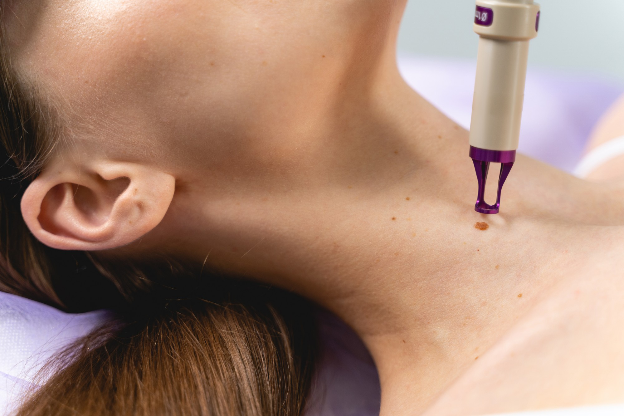 Femme allongée recevant un traitement d'angiome rubis sur son cou et son épaule avec un appareil médical d'électrocoagulation à pointe violette.