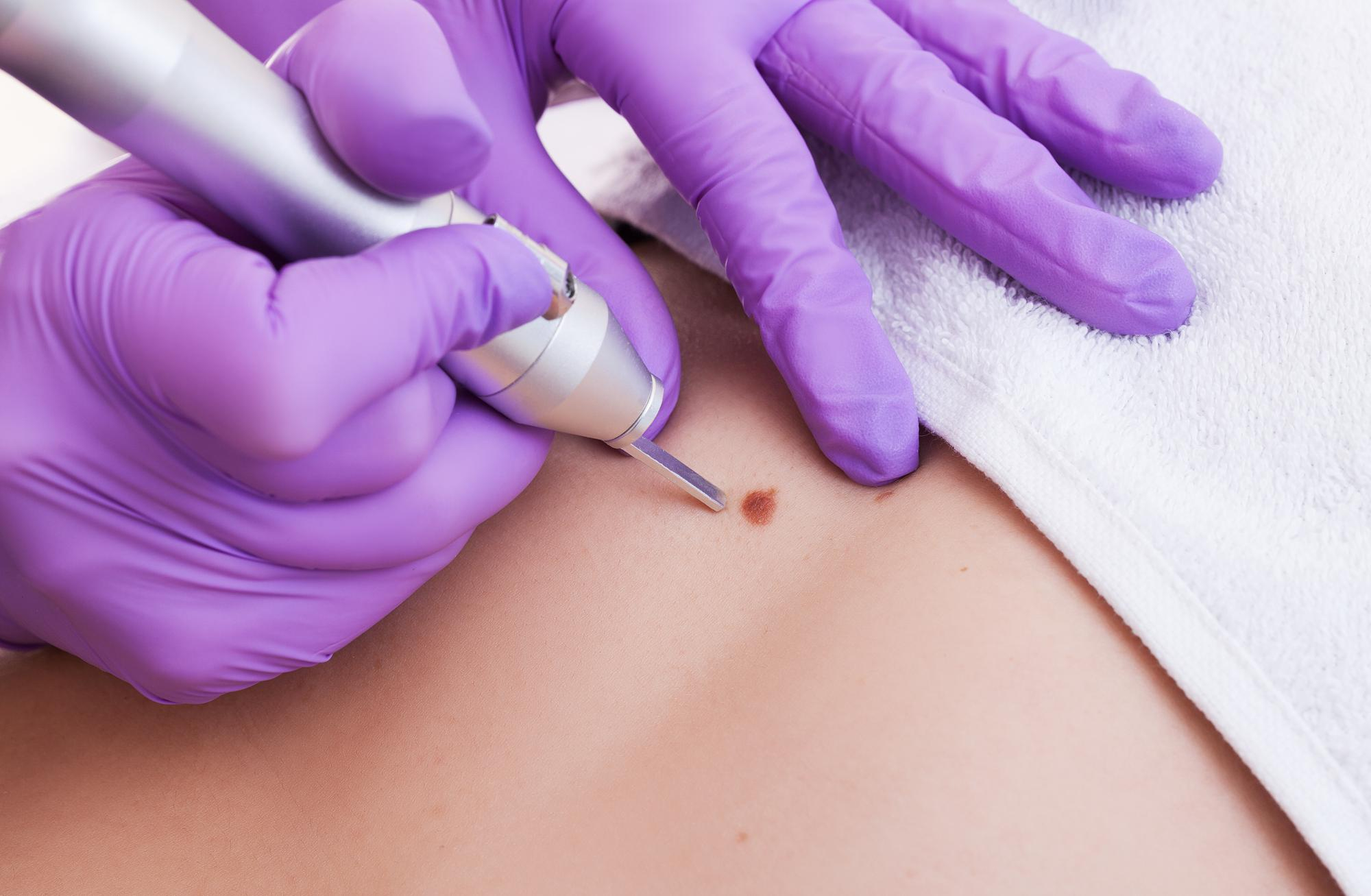 Professionnel en gants violets effectuant un traitement d'angiome rubis sur la peau du patient avec un appareil d'électrocoagulation de précision.