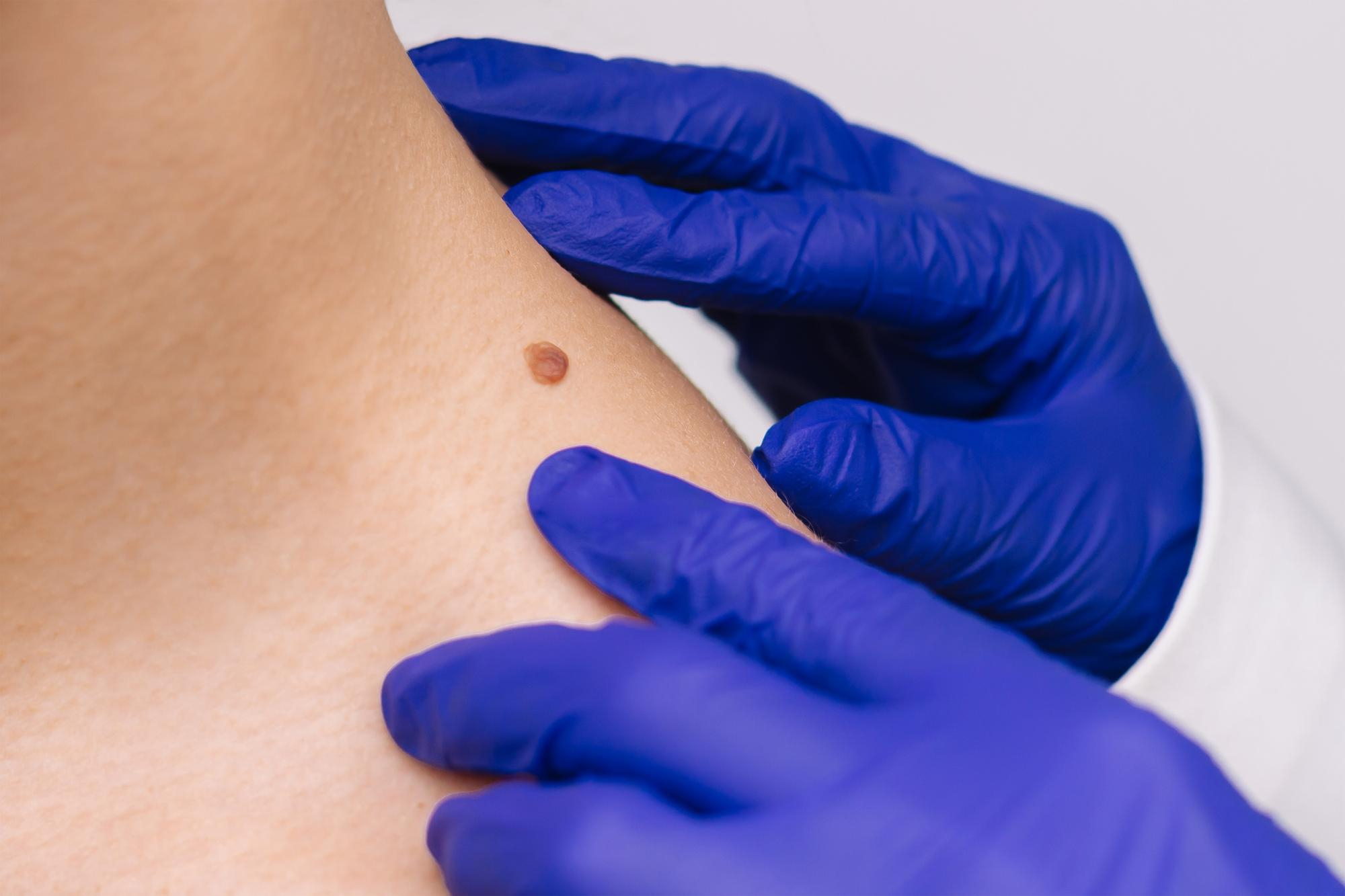 Professionnel médical ganté en gants de latex bleus examinant de près un petit angiome rubis brun sur l'épaule dénudée d'un patient.