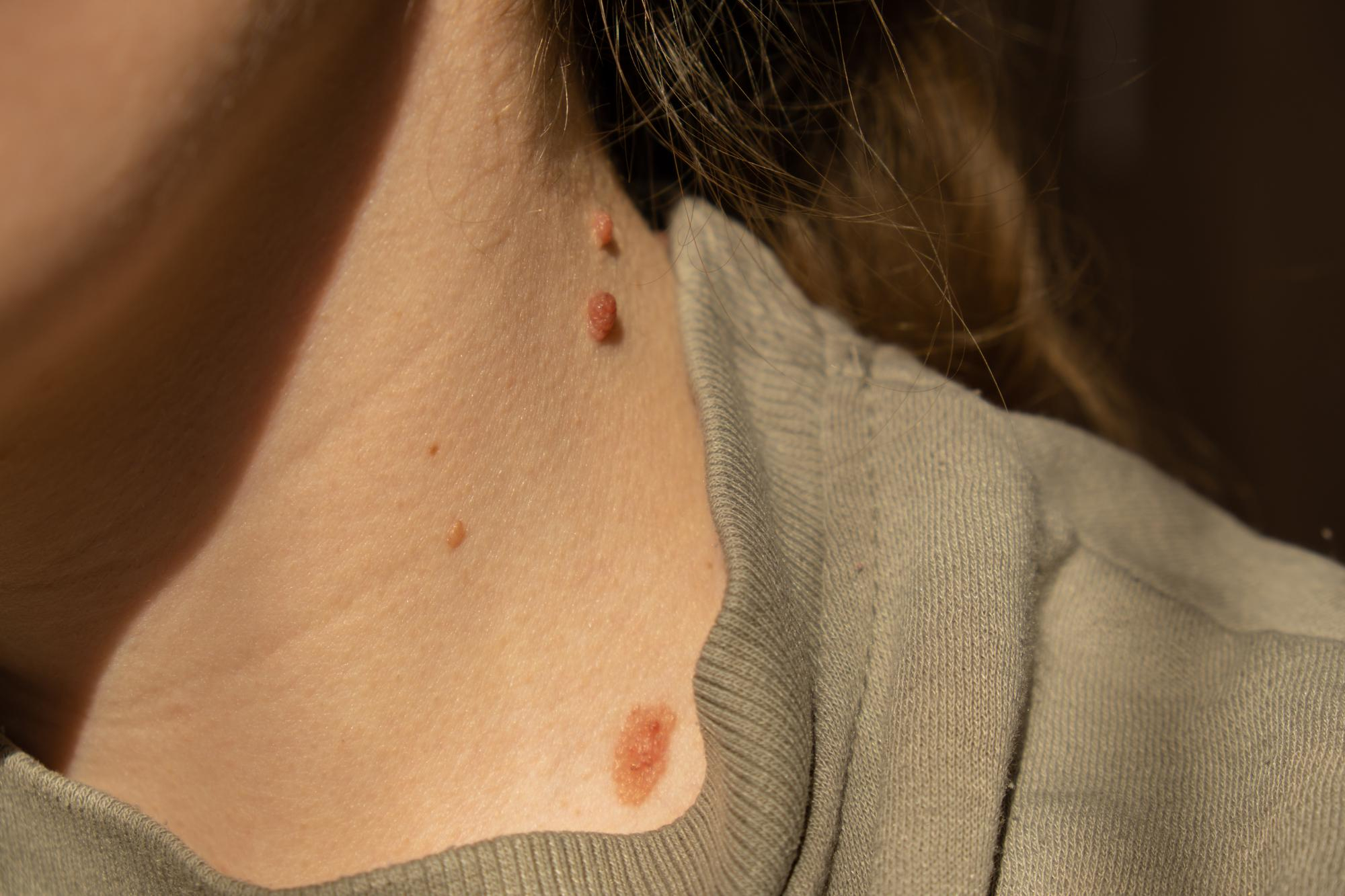 Vue de dos d'une femme aux cheveux attachés révélant plusieurs angiomes rubis rouges et bruns visibles sur son cou et épaule.