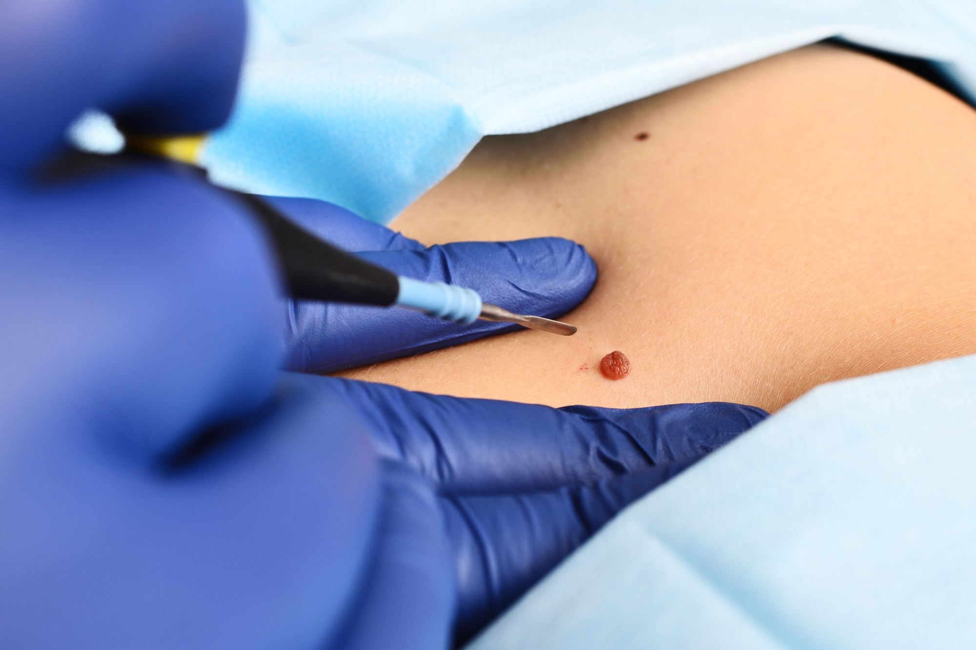 Professionnel en gants bleus réalisant un traitement d'angiome rubis sur l'abdomen d'un patient à l'aide d'un dispositif médical.
