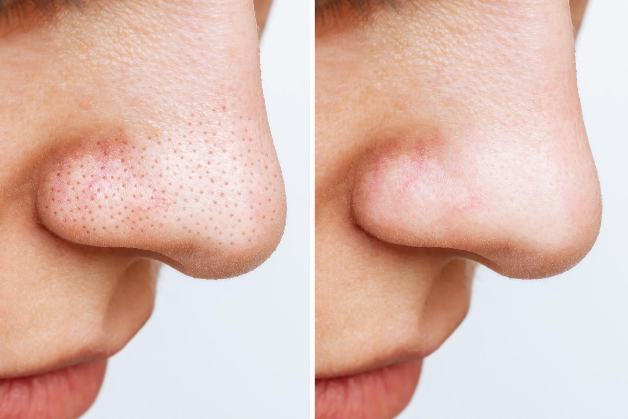 Comparaison avant-après des pores dilatés sur le nez montrant une réduction visible de la taille des pores après traitement.