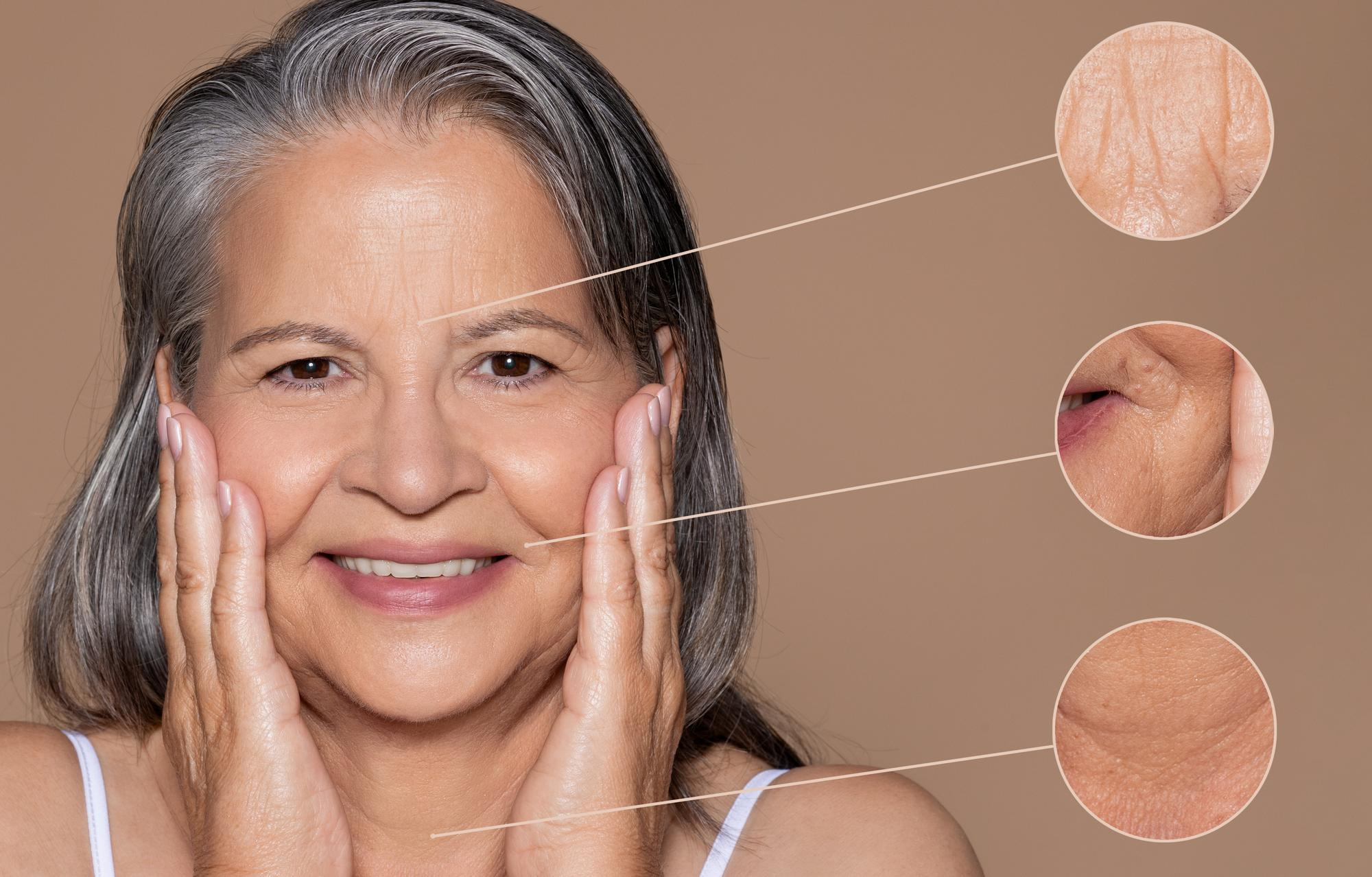 Femme mature souriante tenant son visage avec zoom sur les rides et pores dilatés en vieillissant sur le front et les joues.