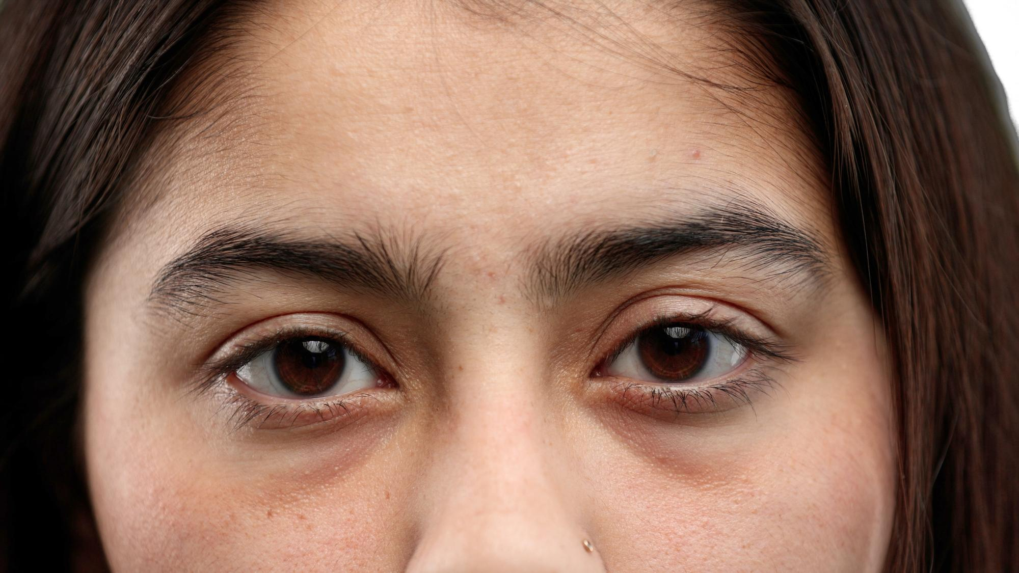 Gros plan des yeux d'une jeune femme aux cheveux foncés montrant une paupière tombante très marquée et des cernes bien prononcés.