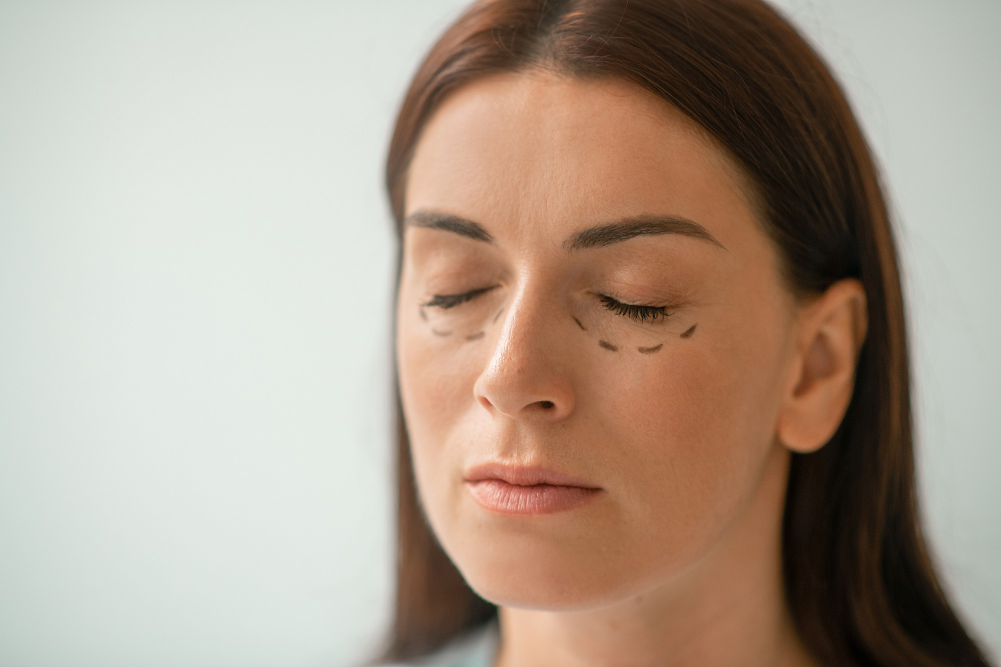 Femme aux yeux fermés avec des marques chirurgicales tracées sous les yeux pour une blépharoplastie sans chirurgie en clinique.