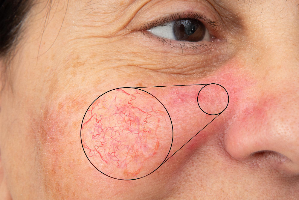La joue et le nez d'une femme mûre laissent voir des varicosités du visage, élargies, révélant de fins capillaires rouges. 