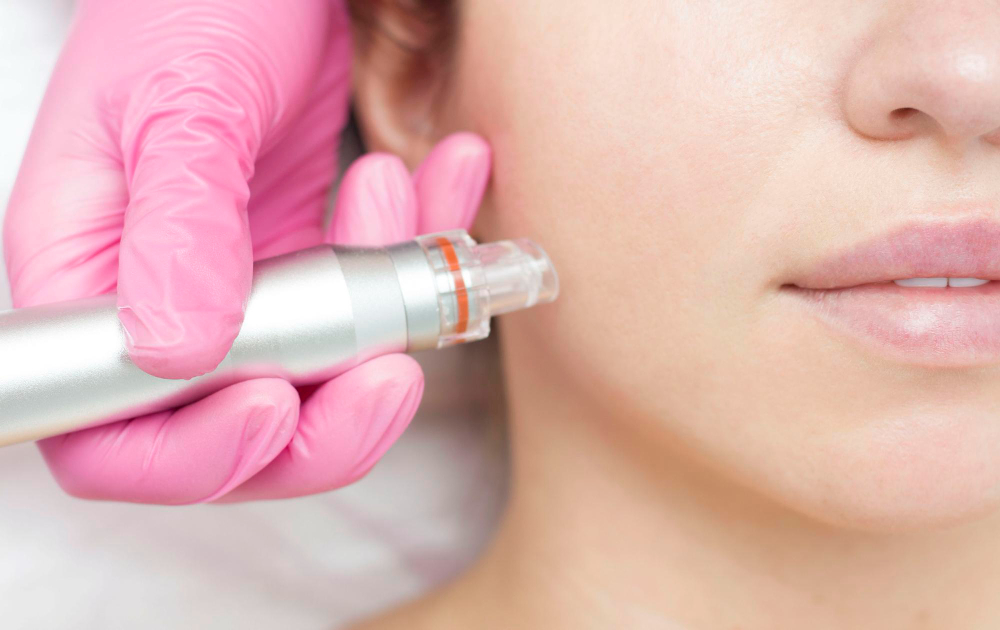 Professionnelle en gants roses qui réalise un traitement plasma fibroblaste sur la joue et le cou d'une patiente en clinique.