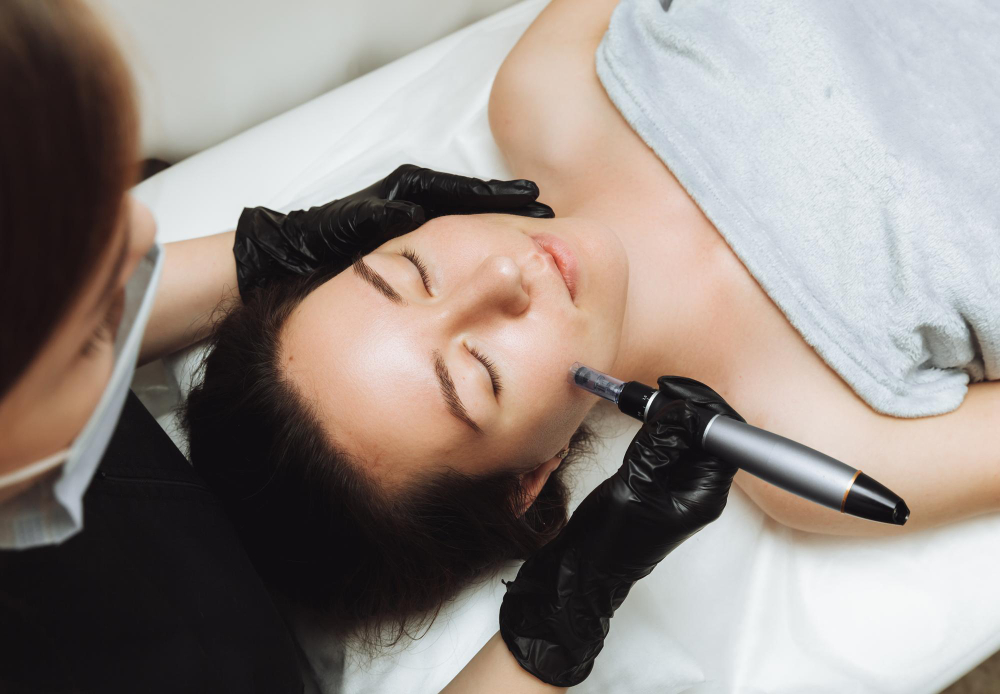 Étape d'une séance de «microneedling» près de la joue d'une cliente allongée.