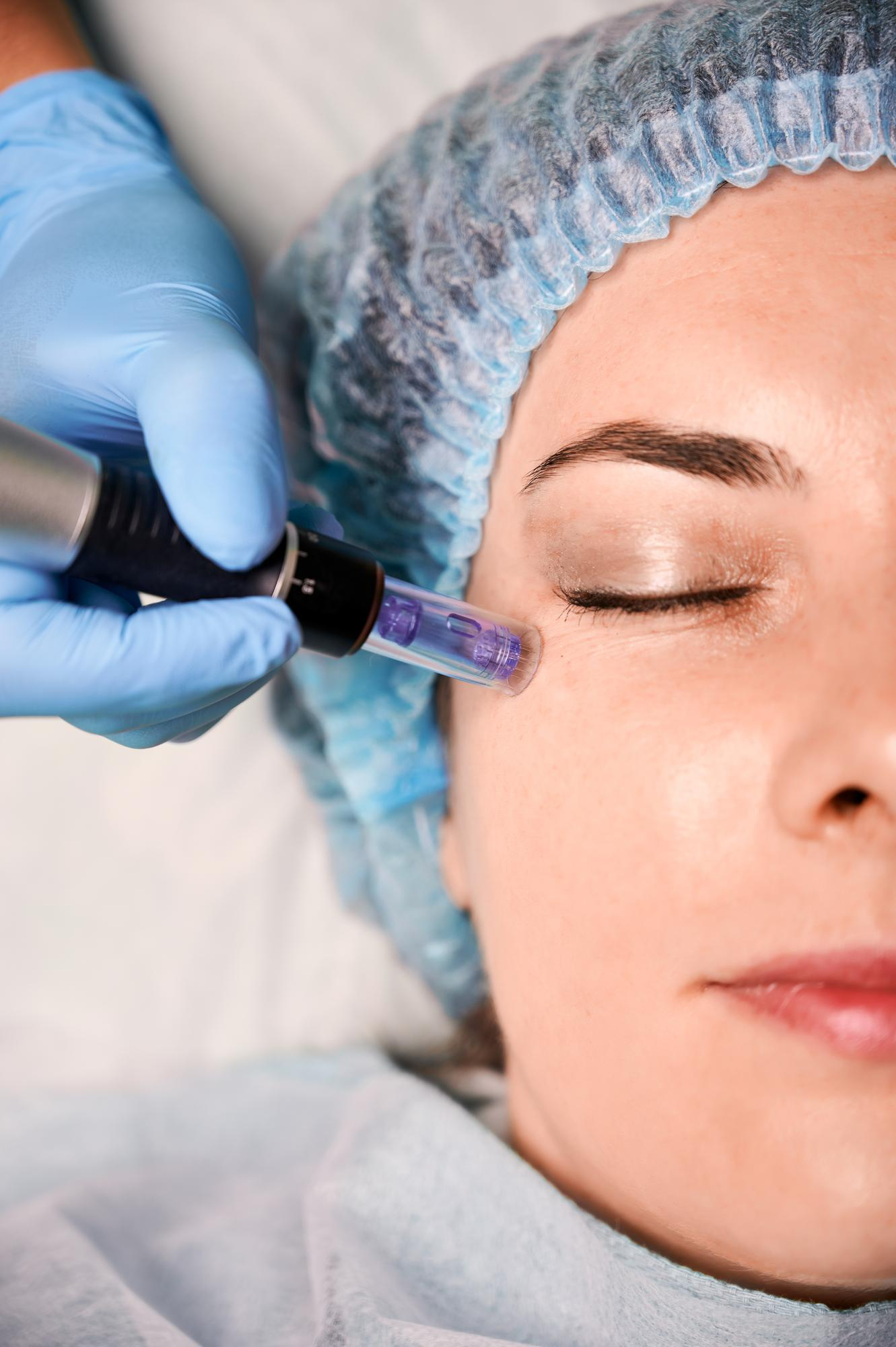 Traitement de microneedling au stylo dermapen sur le contour de l'œil en institut de beauté.