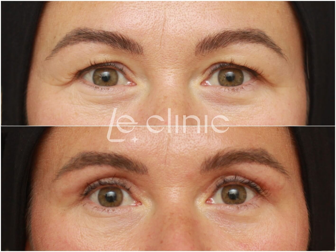 Blefaroplastika hornich vicek v LE Clinic