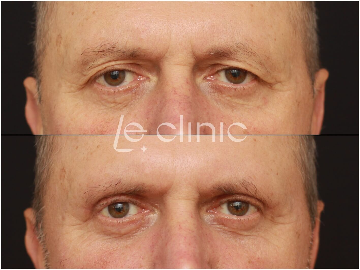 Blefaroplastika hornich vicek v LE Clinic u muze