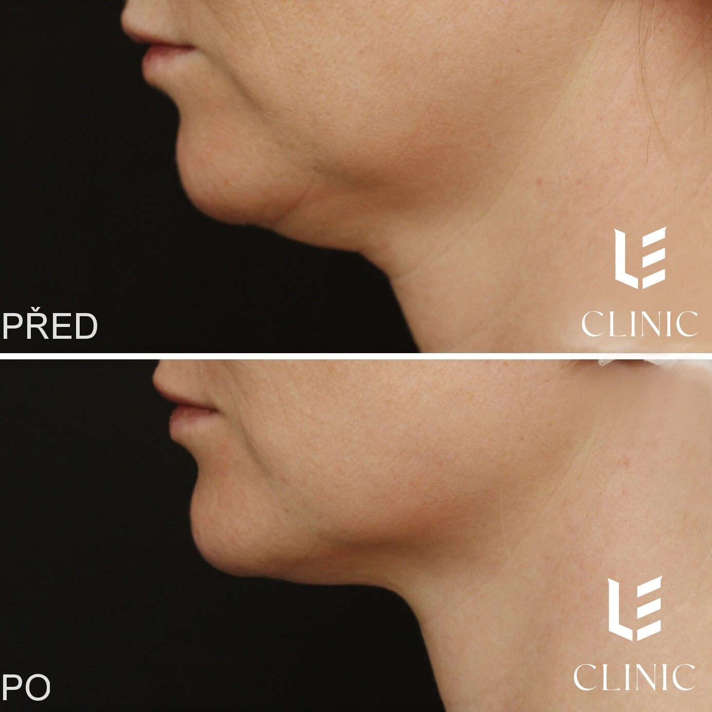 Neinvazivni odstraneni podbradku pomoci CoolSculpting v LE Clinic