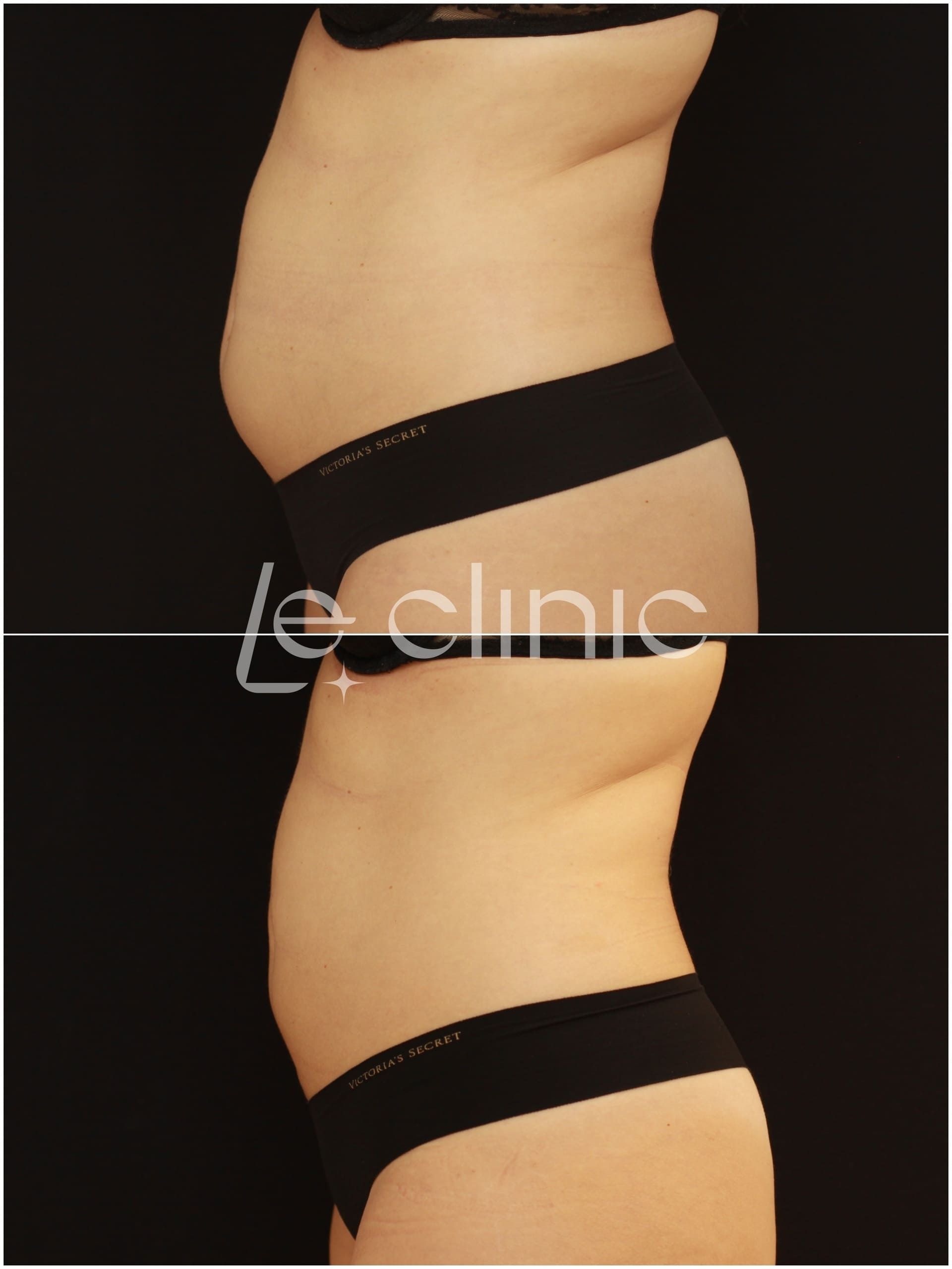 pred a po osetreni na pristroji coolsculpting v LE CLINIC