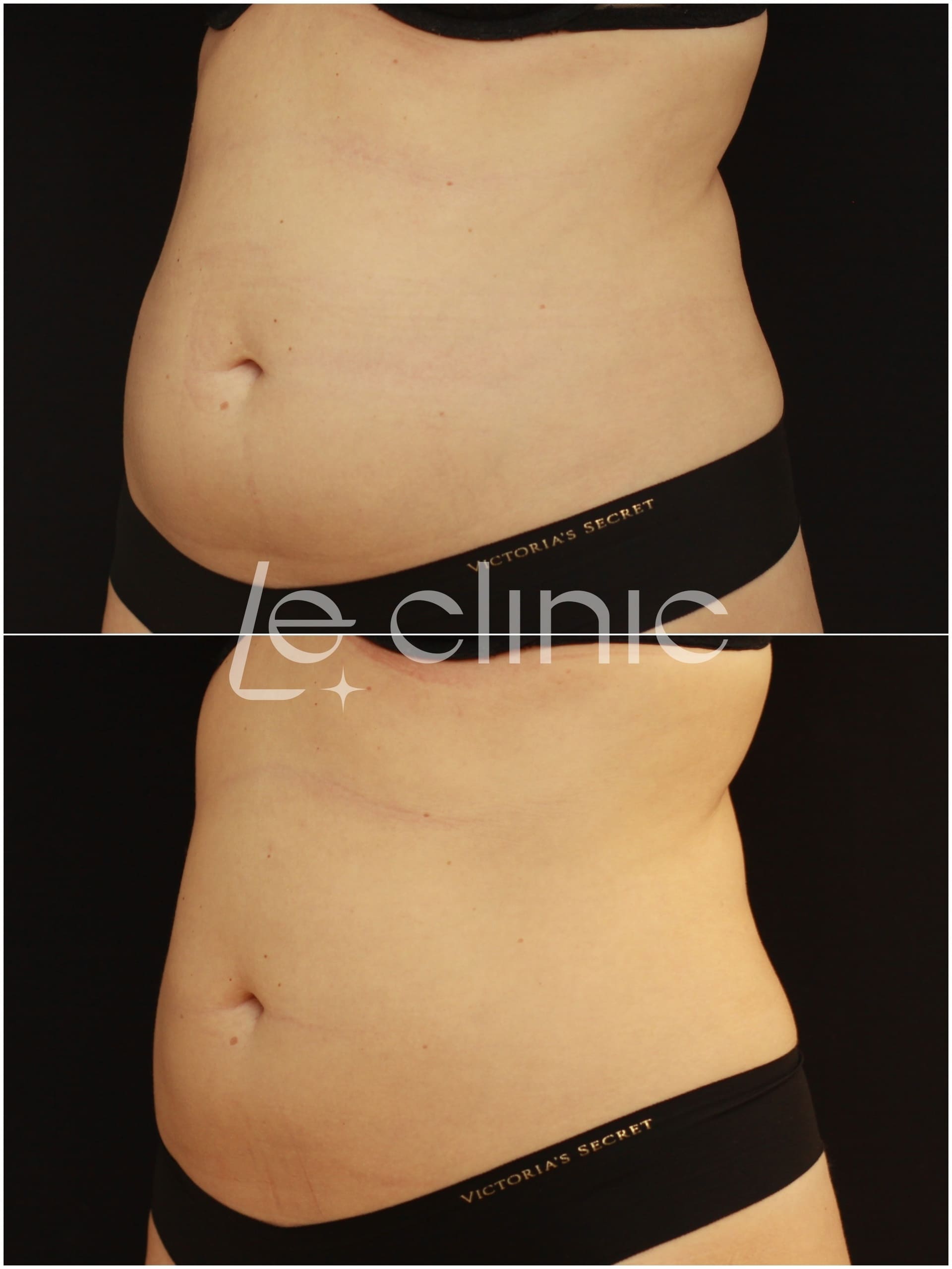 pred a po osetreni na pristroji coolsculpting v LE CLINIC