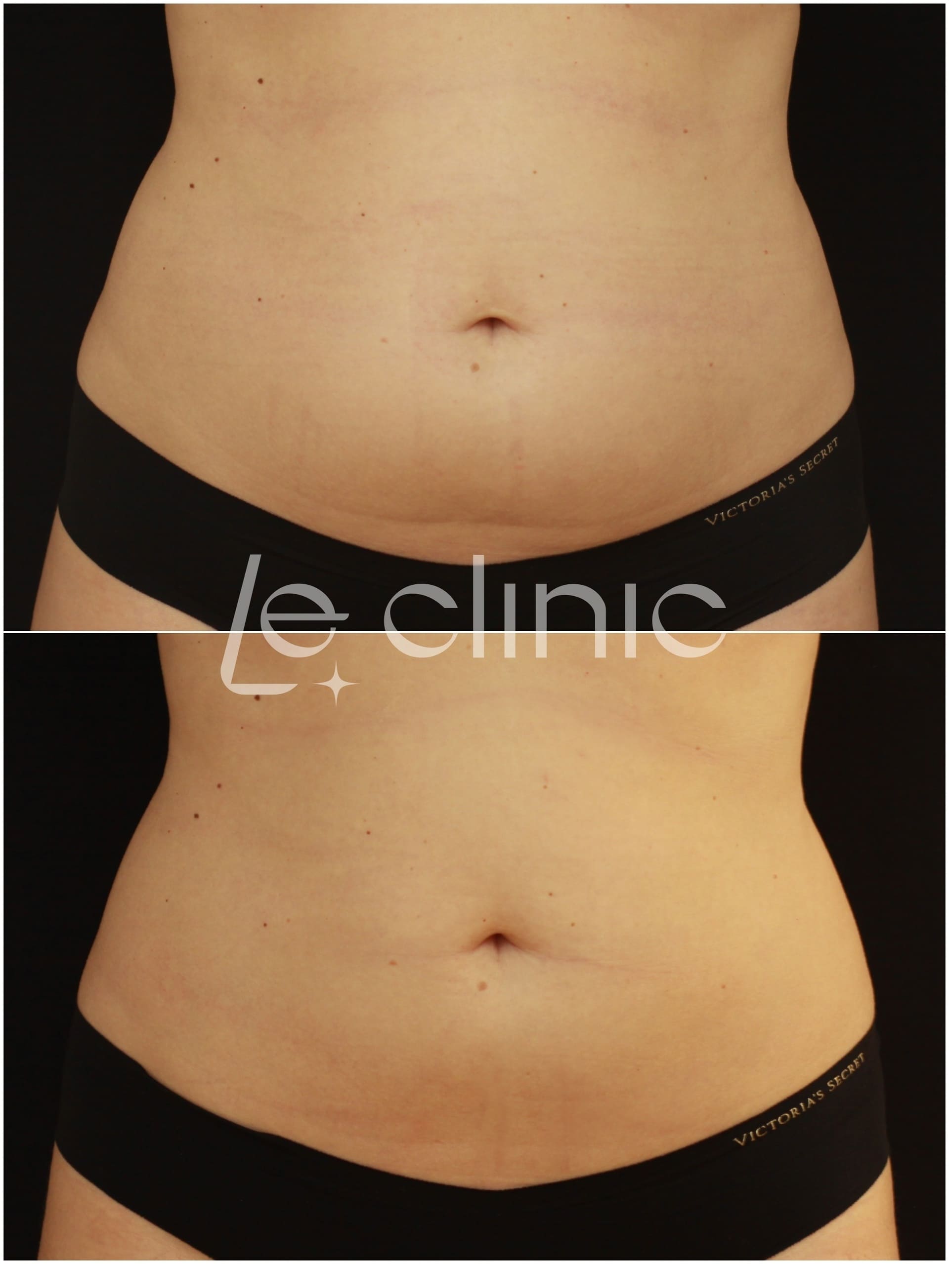 pred a po osetreni na pristroji coolsculpting v LE CLINIC