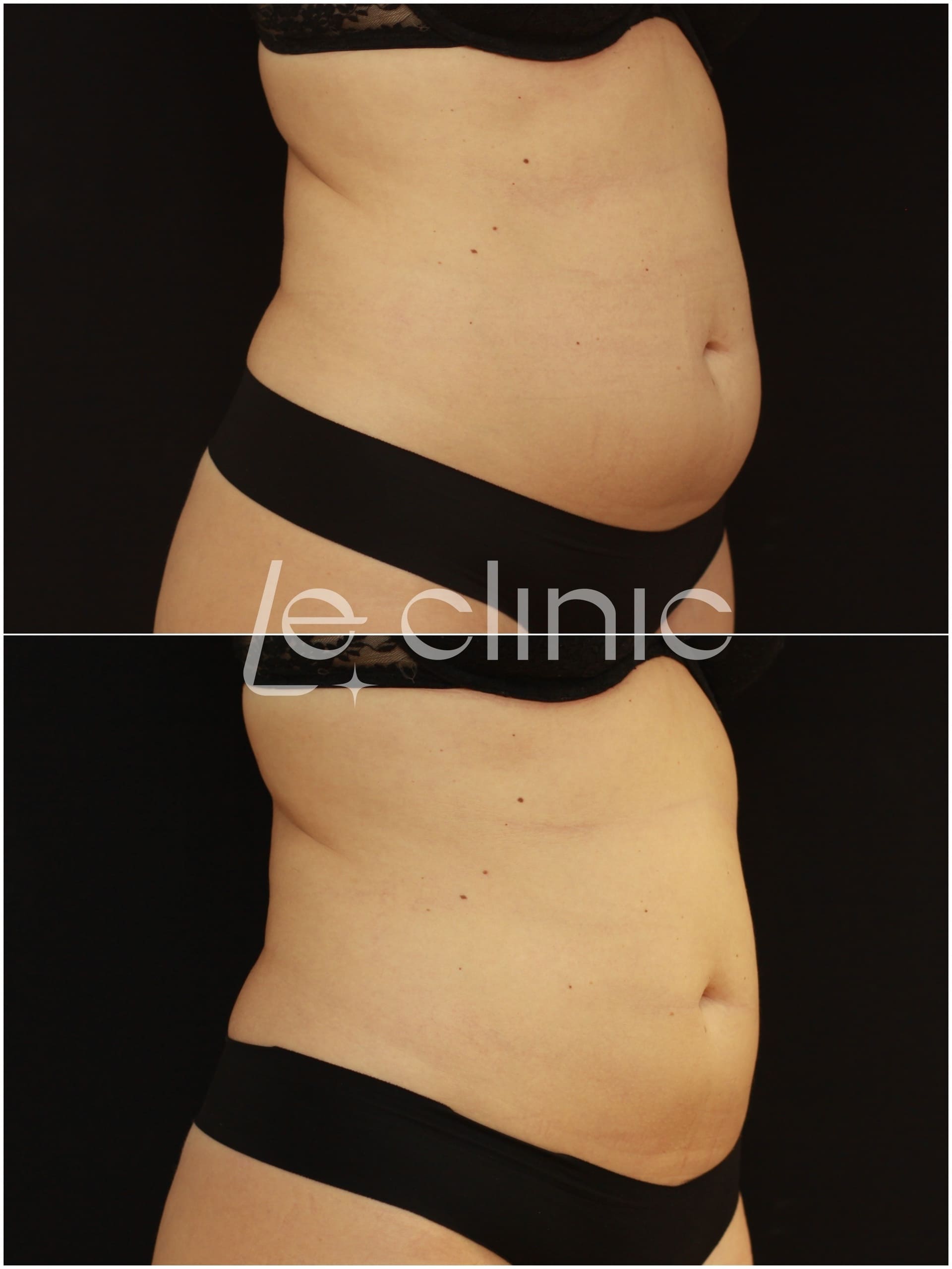 pred a po osetreni na pristroji coolsculpting v LE CLINIC