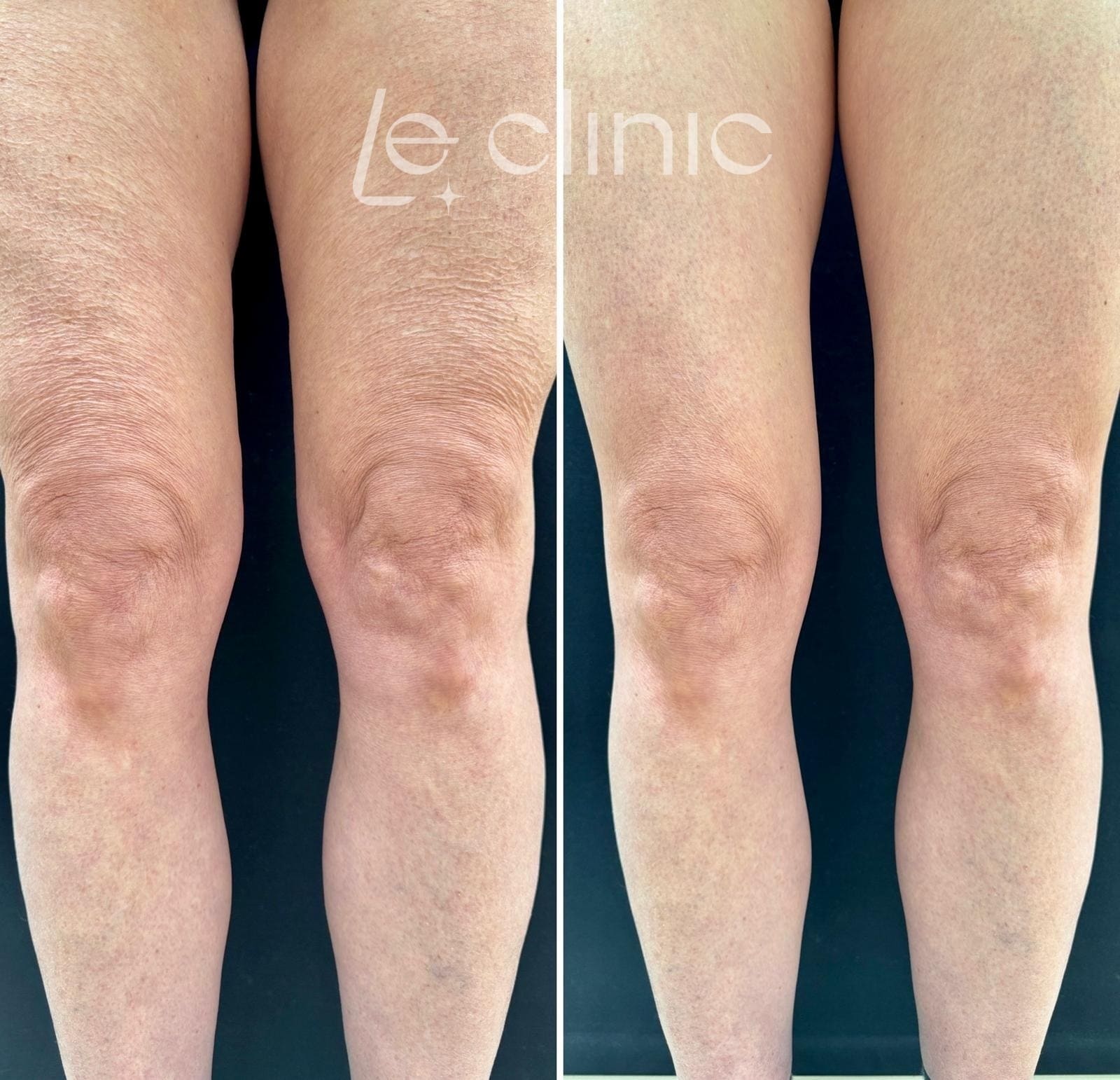 Mikrojehlickova radiofrekvence Morfeus8 v LECLINIC stehna