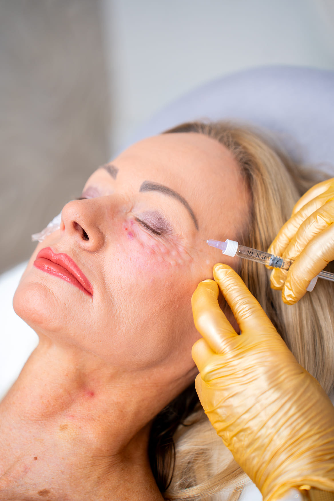 Biostimulace pleti Rejuran v LE CLINIC