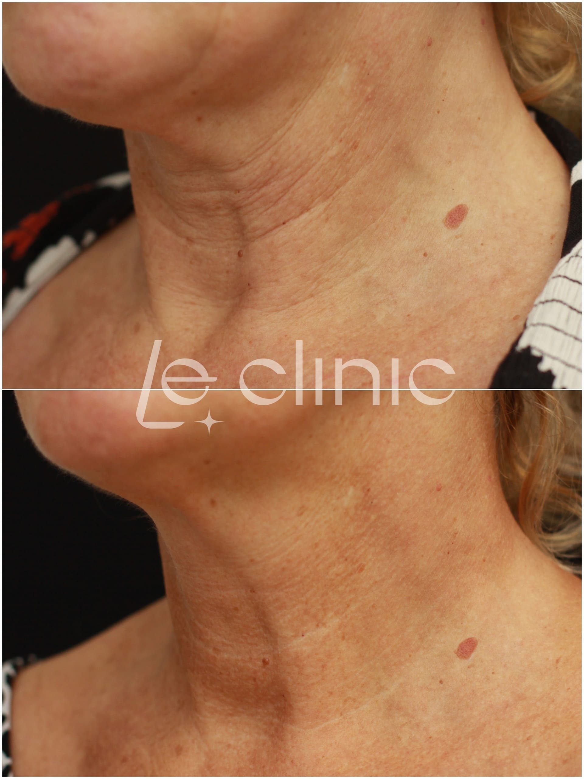 Biostimulace pleti v LE Clinic pred a po