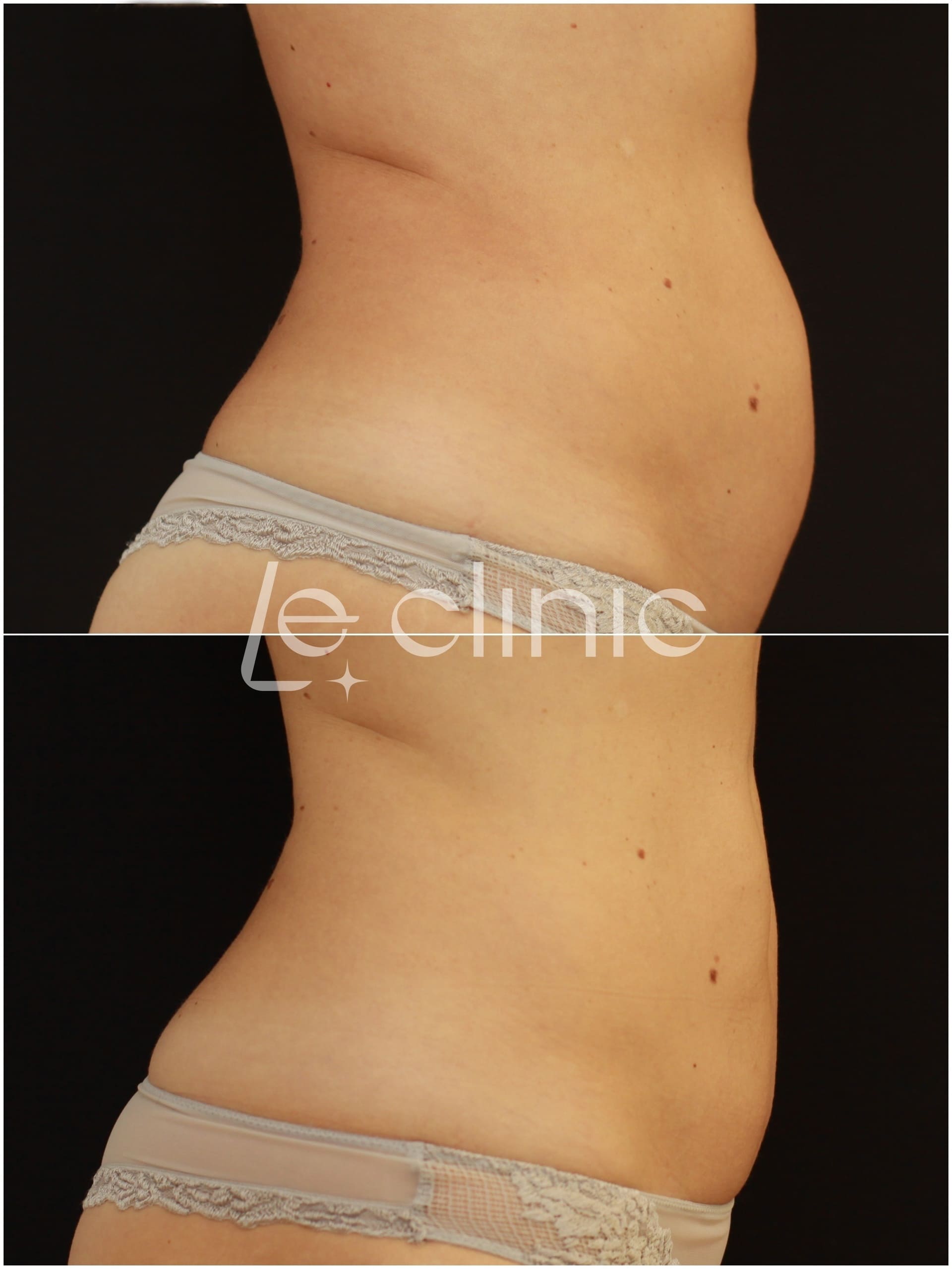 Výsledek Před a Po ošetřeni neinvazivni odstraneni tuku v LE Clinic