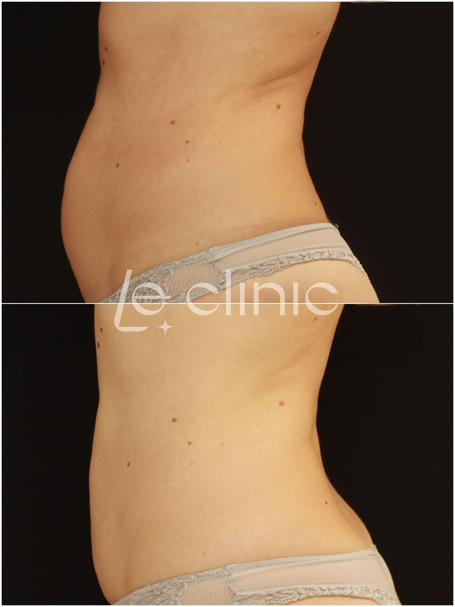 Výsledek Před a Po ošetřeni neinvazivni odstraneni tuku v LE Clinic
