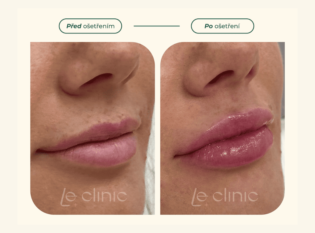 modelace rtu pred a po v LE CLINIC