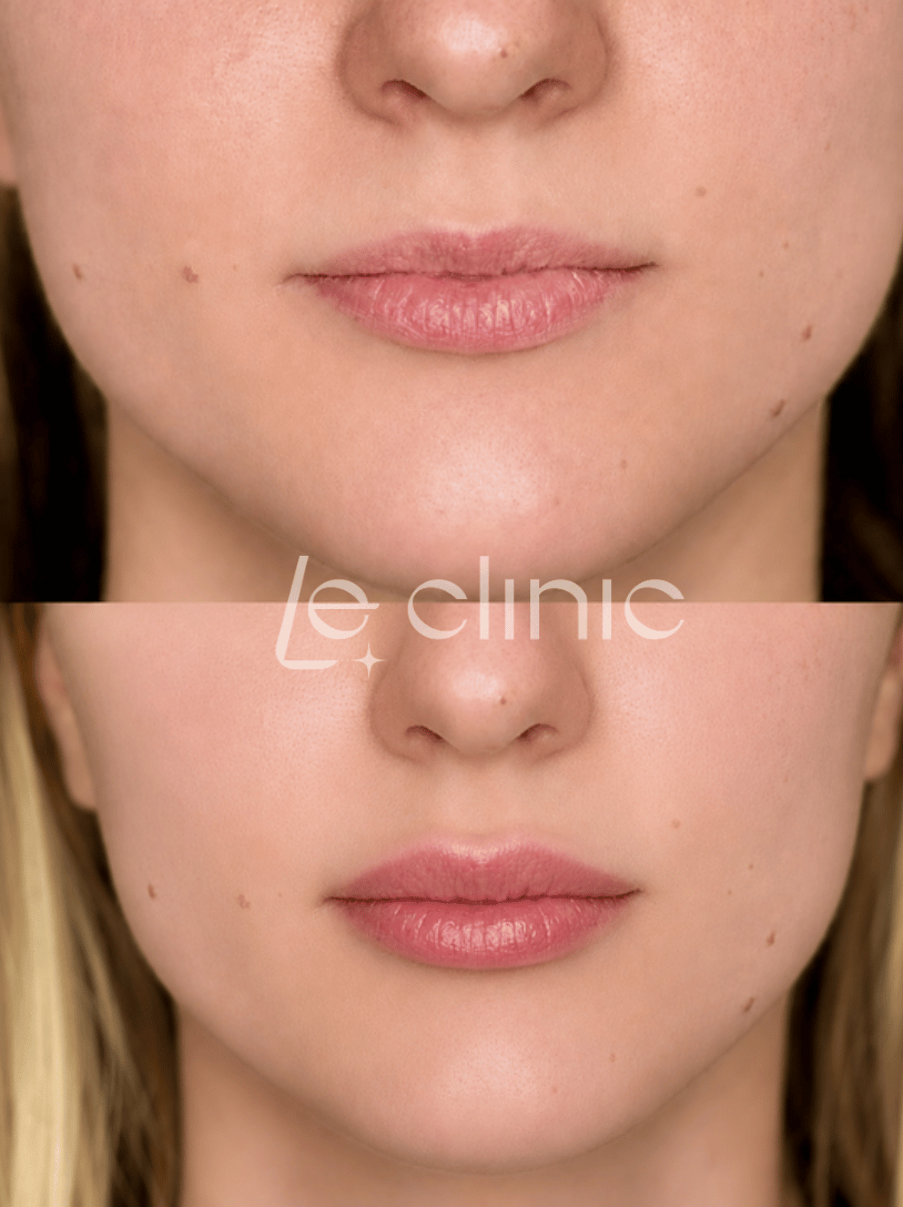 Modelace rtů výplní LE CLINIC
