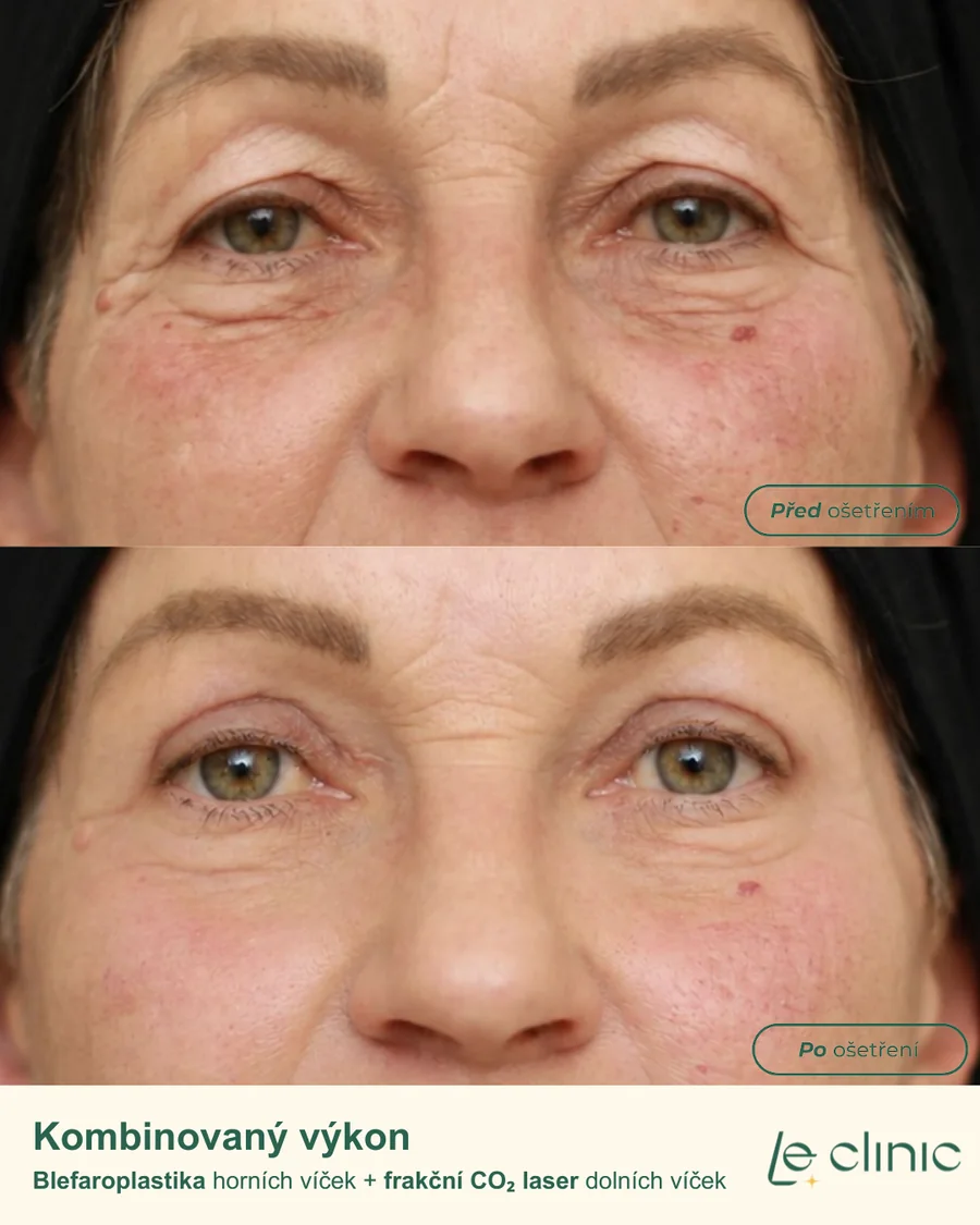 Oční okolí před a po kombinovaném zákroku: blefaroplastika horních víček a frakční CO₂ laser dolních víček