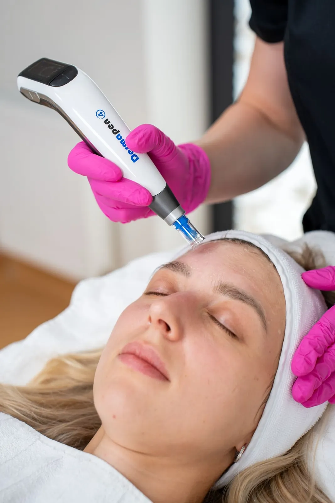 Mikrojehličkování čela klientky přístrojem Dermapen 4 MD