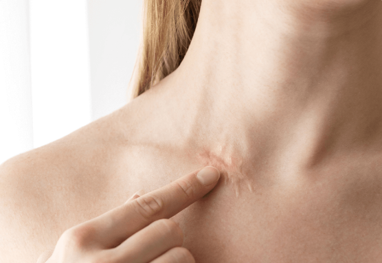 Faciatherapie bij littekens