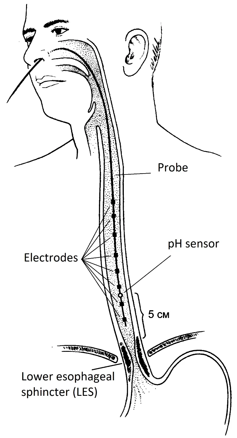 Medical illustration of ph monitor inside an esophagus