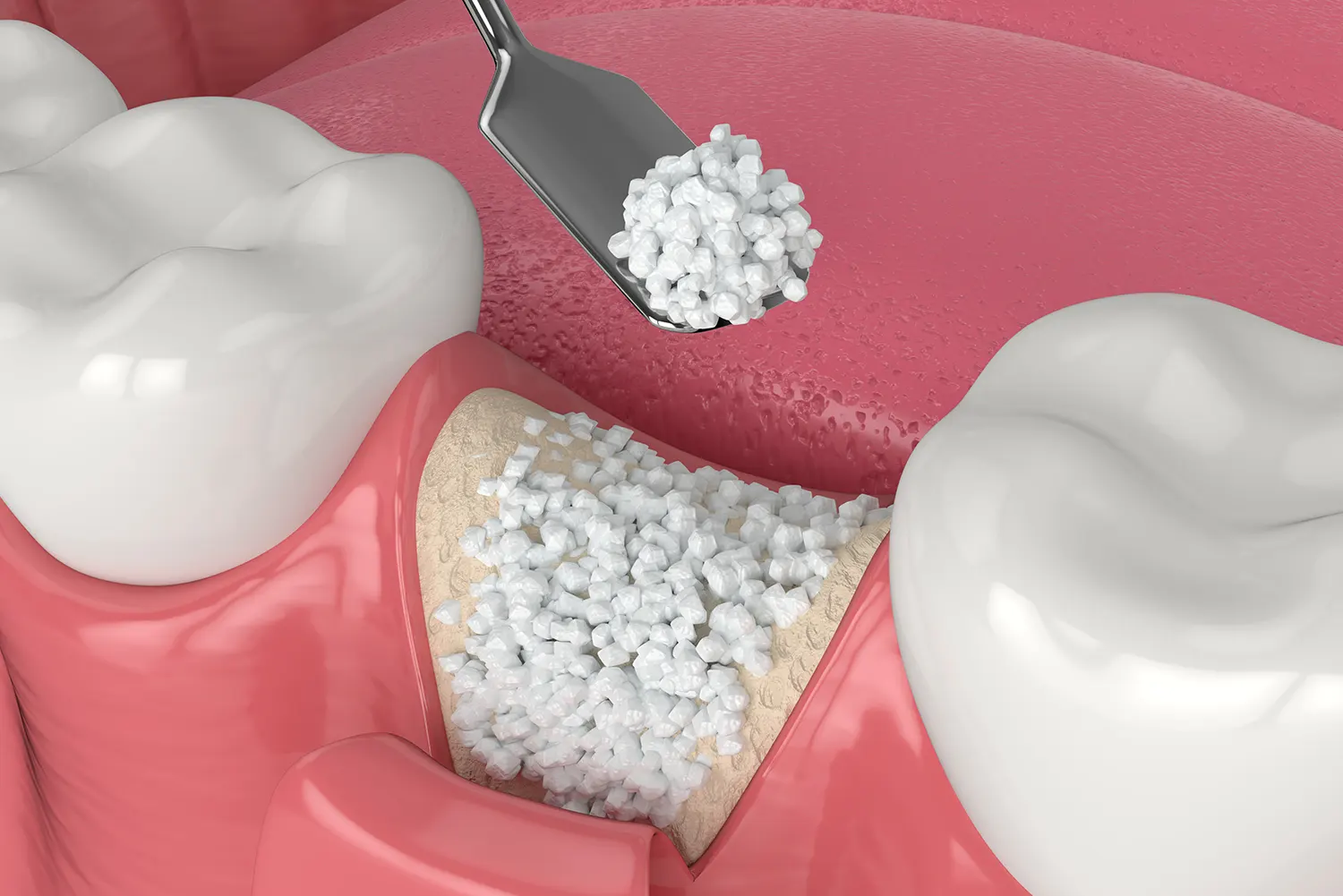 Bone Grafting in New Orleans | Crescent City Smiles
