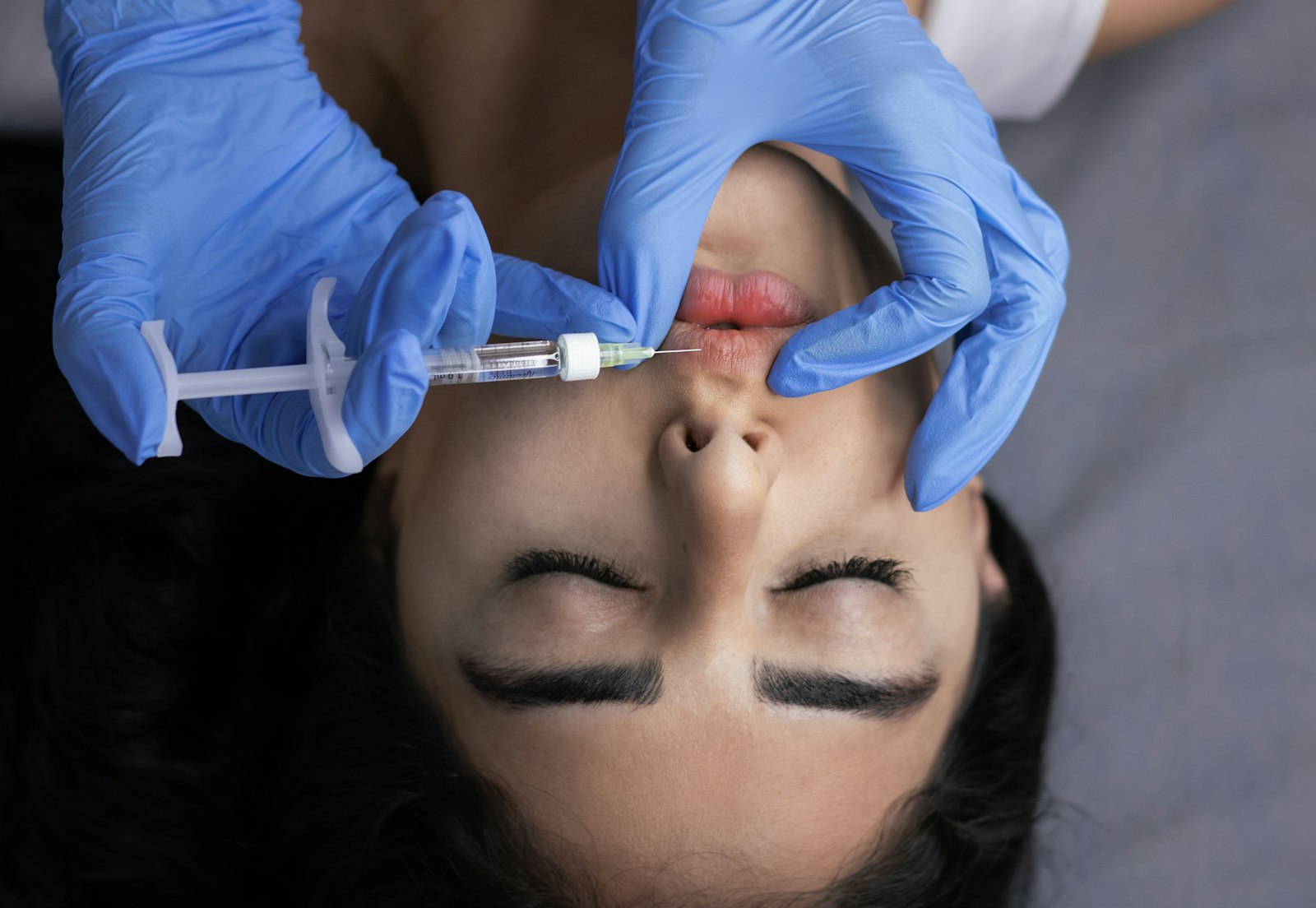 Injection d'acide hyaluronique dans la lèvre, réalisée avec des gants stériles
