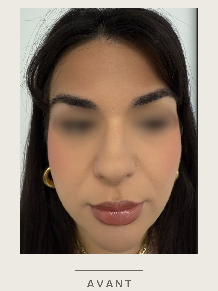 Botox du nez, vue de face avant traitement