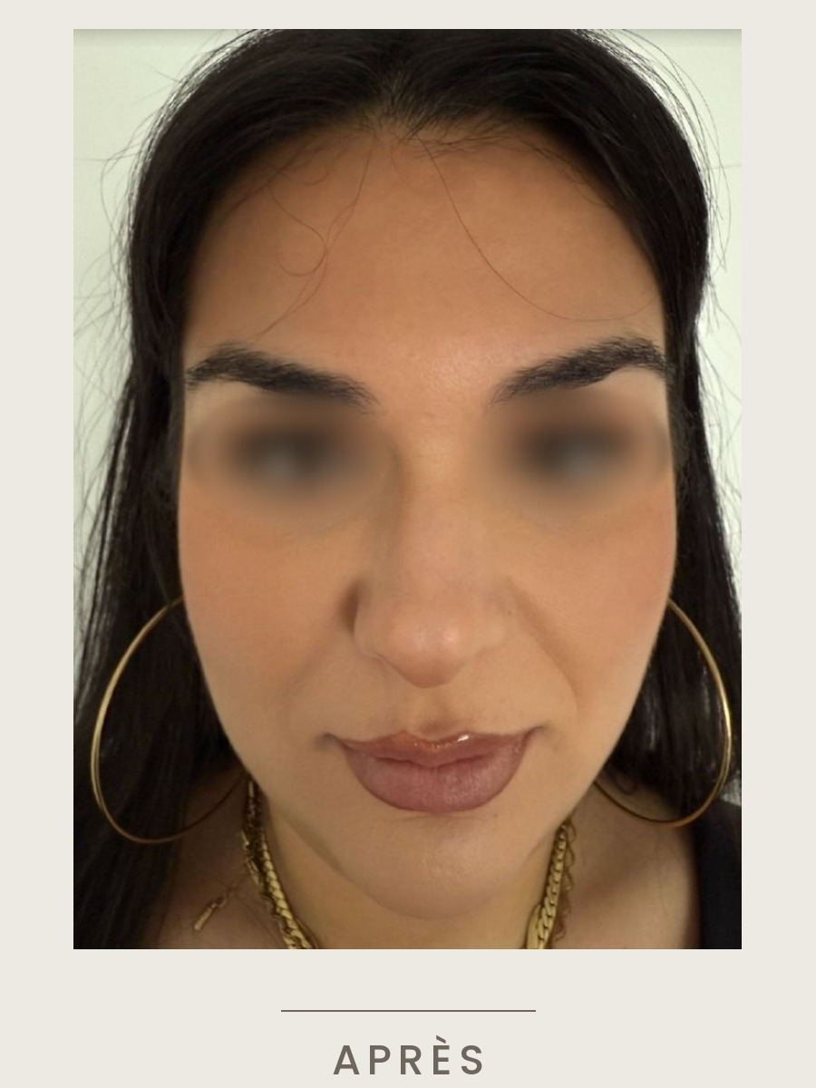 Botox du nez, vue de face après traitement