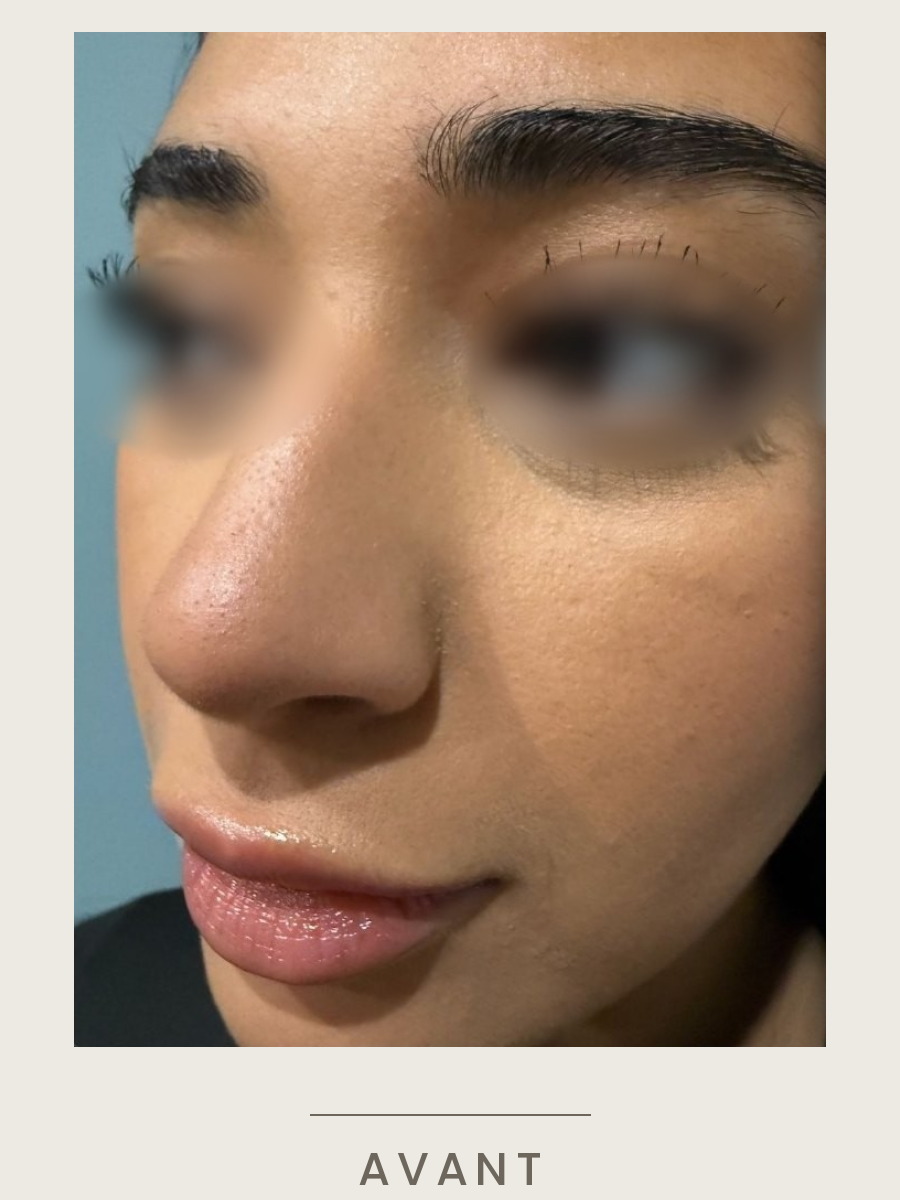 Botox du nez, vue de trois quarts avant traitement